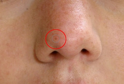 The spot healing brush is placed over a second pimple.
