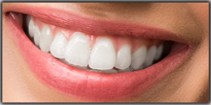 Teeth whitening and brightening